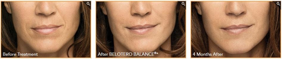 Belotero Balance NYC