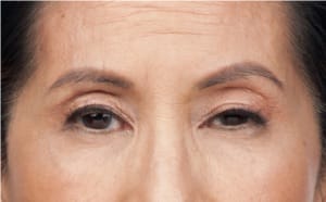 BOTOX in NJ