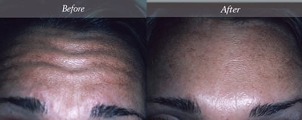 Botox NYC