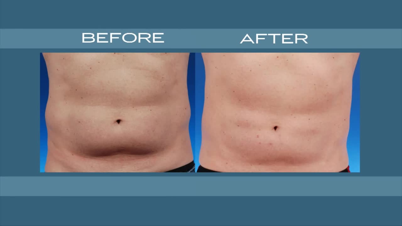 CoolSculpting in NYC