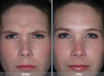 Dysport injections NJ