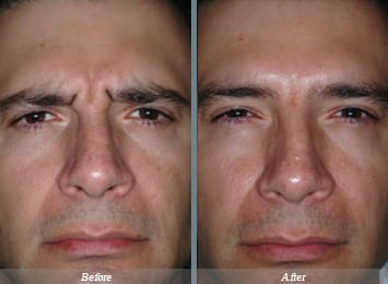 Dysport injections NYC