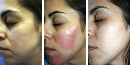 eMatrix Skin Rejuvenation NYC