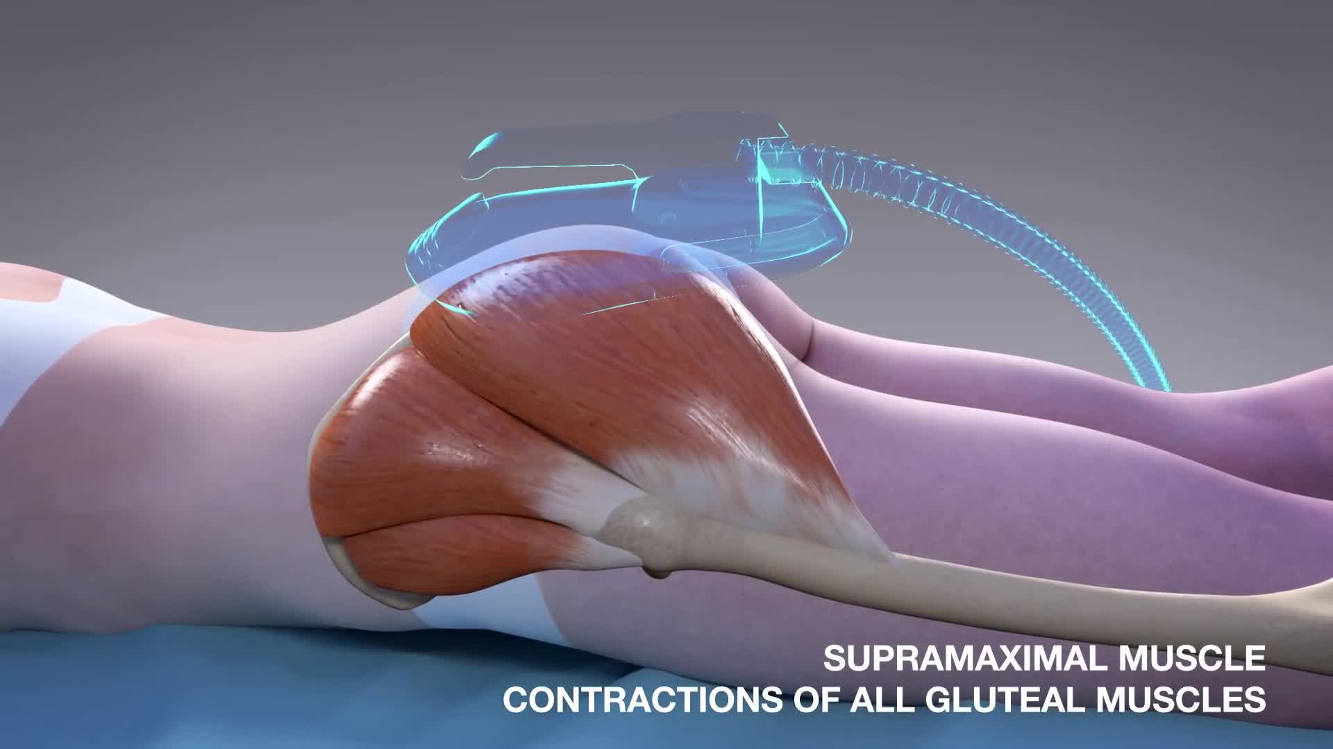 NJ Emsculpt