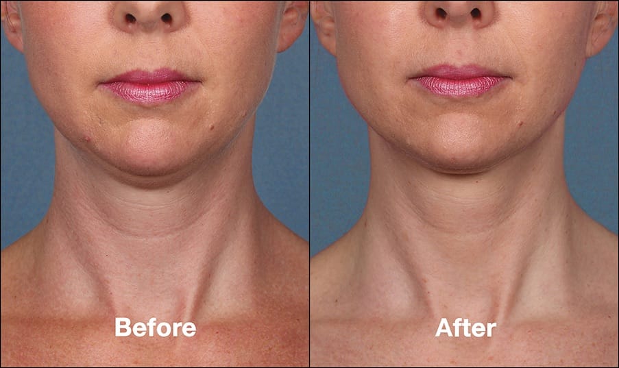 Kybella NYC