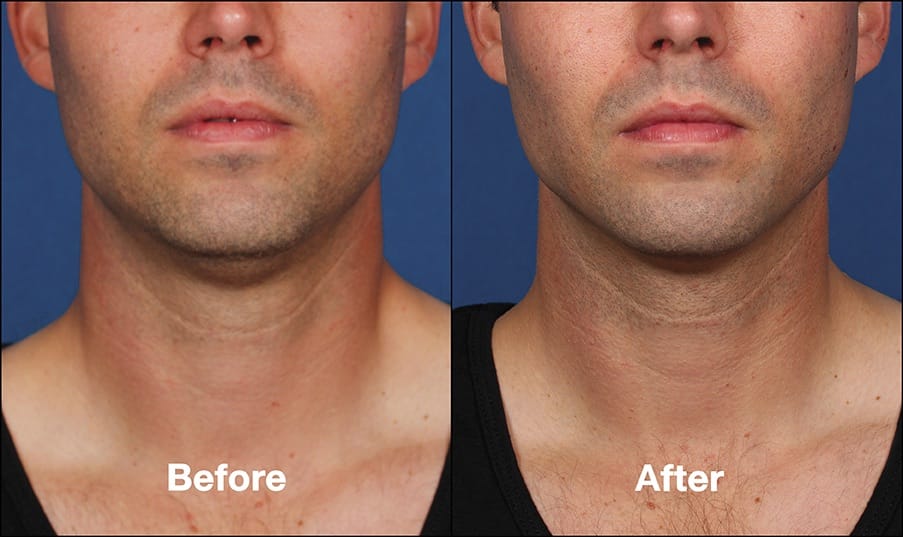 Kybella NYC