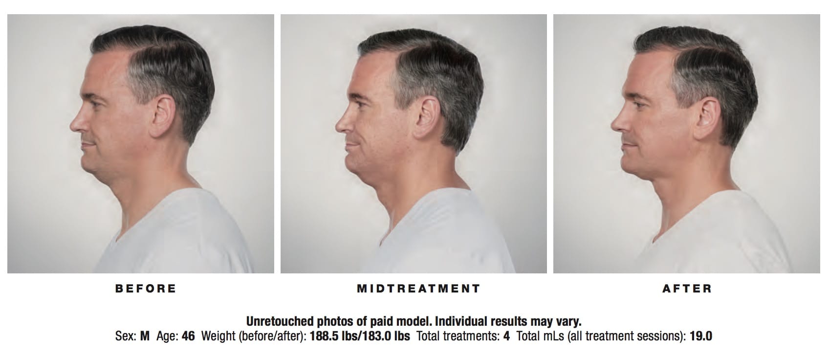 Kybella in NJ