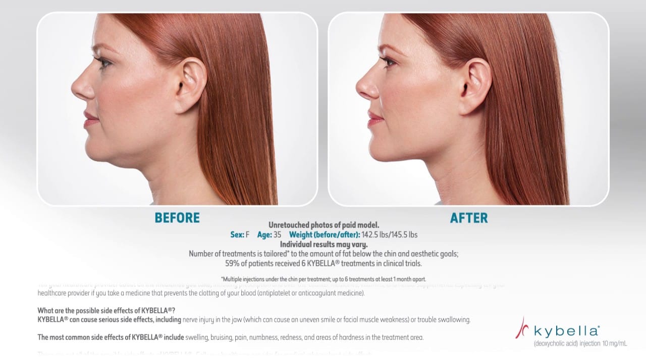 Kybella in NYC