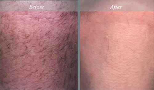 NJ Laser Hair Removal