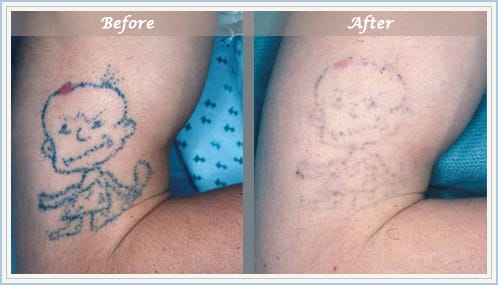 NJ Laser Tattoo Removal