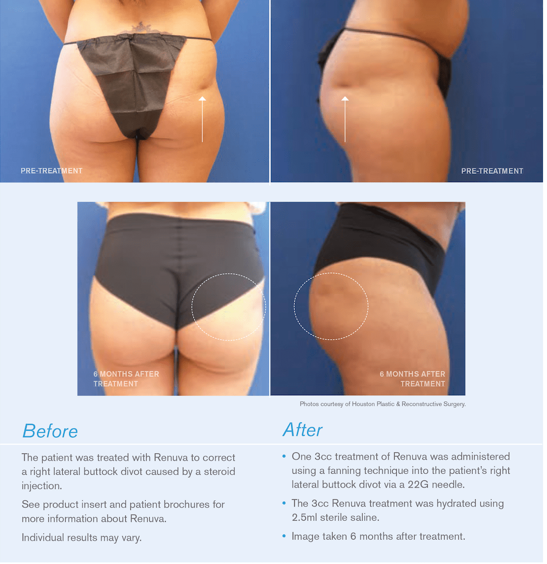 RHA Fillers NJ
