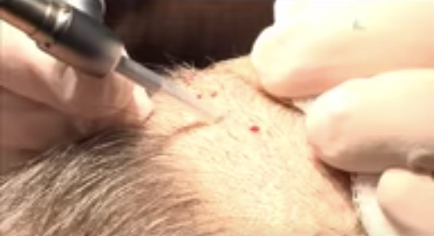 nyc neograft