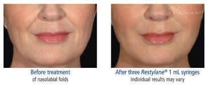 Restylane NJ