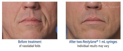 Cosmetic Injections in NYC