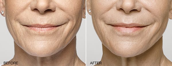 Restylane NYC