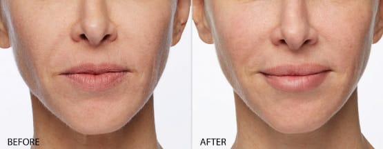 Restylane NYC