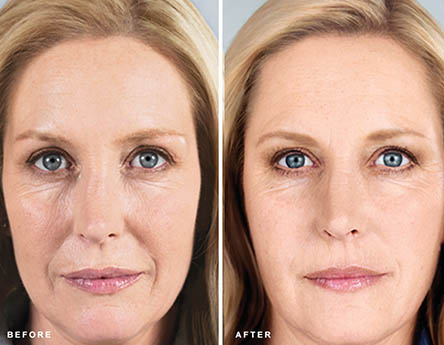 Sculptra Facial Contouring in NYC
