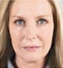 Sculptra Facial Contouring in NYC