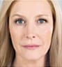 Sculptra Facial Contouring in NYC