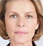 Sculptra Facial Contouring in NYC