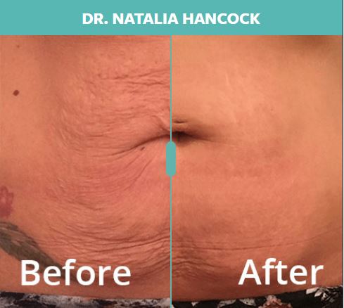 Fractora Skin Rejuvenation NYC