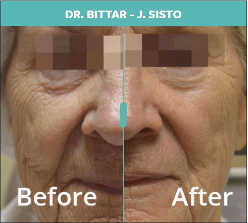 Fractora Skin Rejuvenation NYC